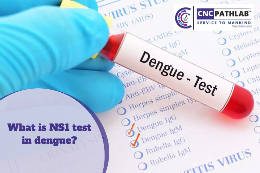 What Is NS1 Test In Dengue?